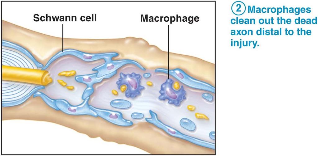 b. Axon distal to cut dies: (Wallerian degeneration) c. Schwann cells and macrophages: clean up the debris d.