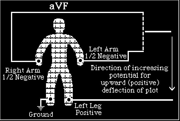 Figure 3.8 LEAD avf Vector In the three previous figures, LEADs, avr, avl and avf are shown below as they are interpreted.