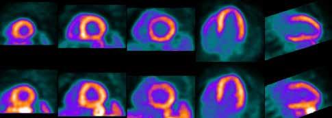 Value-based Cardiac Imaging in CAD Nuclear