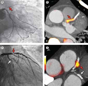 F-18 Sodium Fluoride PET Identifies Ruptured and High-Risk Coronary Plaques 40 AMI 93% uptake in culprit plaque at ICA 40 Stable angina