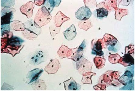 to cancer Cytology Primer ASC-US: atypical squamous cells of undetermined significance LSIL: