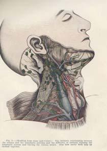 Radical neck dissection (RND) Resection of: All lymph node groups from levels I through V Spinal accessory nerve Internal jugular vein Sternocleidomastoid muscle Radical neck dissection (RND)