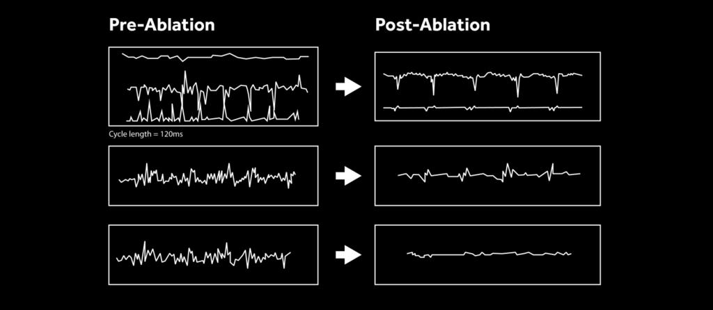 NON-INVASIVE CARDIAC MAPPING IN CLINICAL PRACTICE: APPLICATION TO THE ABLATION OF CARDIAC ARRHYTHMIAS Description of clinical experience in using non-invasive mapping technique to identify the