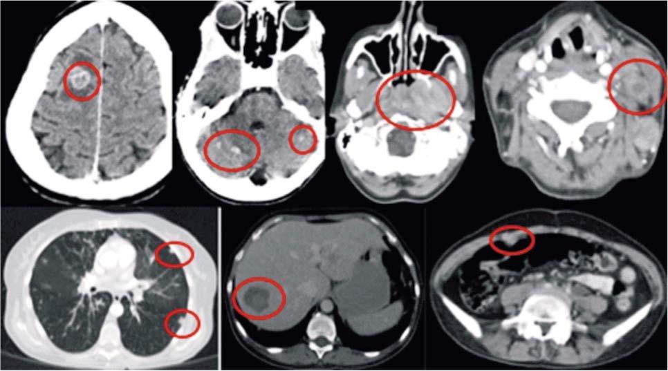 74 Matei Bârã et al Figure 3. CT scan show progresion of disease cancer develop a SC in the head and neck region with an increased incidence, than the general population.
