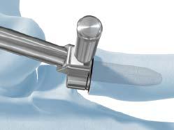 Secure the implant stem to the stem inserter/extractor by turning the knob and threading the stem onto the instrument.
