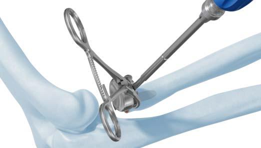 trial reduction. Assemble the implant head to the implant stem by hand or using the reduction forceps.