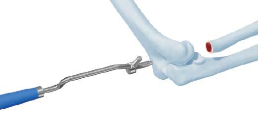 Implants 2 Remove implant stem Instruments 03.010.059 Hammer Guide for Slide/Fixed Hammer 03.402.741 Offset Stem Inserter/Extractor 359.