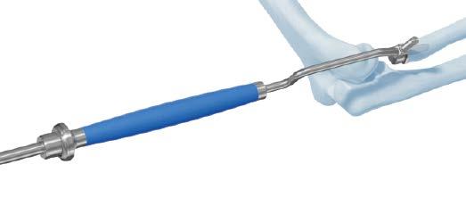 Attach the stem inserter/extractor to the implant stem, as described in Step 9.