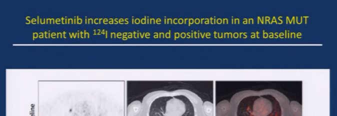 Differentiated Thyroid Carcinoma take home messages: There is hope after radioactive iodine. Many TKIs are active.