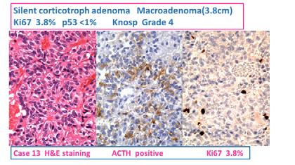 Pituitary adenomas with Ki67 >3% M/ 年 GH PR AC FS TS LH H H S U ki-67 P53 AIP Knosp Max Diameter (mm) 診断 F 齢 L TH Clinical history 1 F 42 GH 4+ ± - - - - - 8.