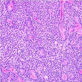 Red: Poor prognosis Functioning Nonfunctioning ACTH secreting Densely granulated ACTH Silent corticotroph subtype I Sparsely granulated ACTH Silent corticotroph subtype II Crooke cell adenoma GH