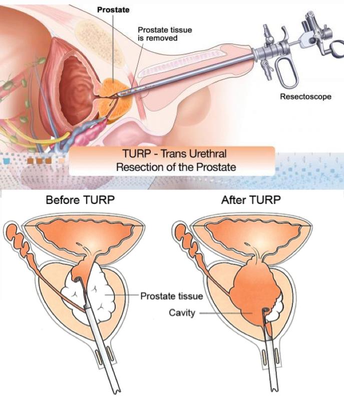 HDR vs LDR Anatomic considerations TURP defect Irregular geometry of TURP defect can be an issue for LDR There may be missing tissue where seeds should be implanted for optimal dose distribution