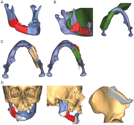 On theweb meeting, the resection area of the mandible was decided by the surgeon and colored on the personal computers by a medical engineer ( Fig. 2A).