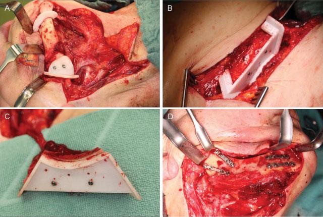 Mandibular Reconstruction Using ProPlan CMF Sasaki, Rasse e37 Fig. 3 Intraoperative photographs with the surgical guides. (A) Intraoperative fitting of the resection guide.