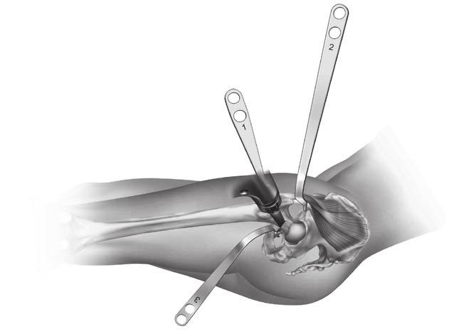 The system is highly compatible with the Zimmer Minimally Invasive Solutions (MIS) hip procedures taught through The Zimmer Institute including the MIS Posterior, MIS Anterolateral, MIS Anterior