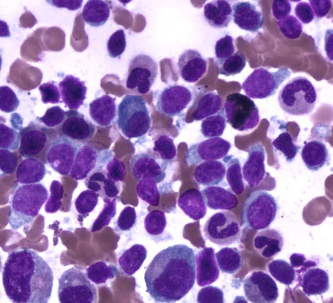 The peripheral blood smear is significant for mild lymphocytosis of cells with cytoplasmic villous extensions consistent with splenic lymphoma with circulating villous lymphocytes.