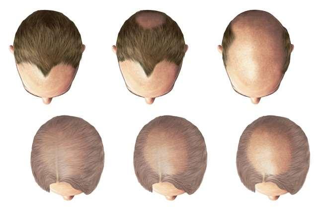 pattern baldness baldness allele is dominant in males but recessive in females a heterozygous male is bald, but a heterozygous