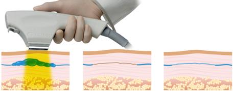 How do BBL Vascular treatments work BBL treatment to Small Vessels During BBL Treatment BroadBand Light penetrates the skin to reach the blood vessel.