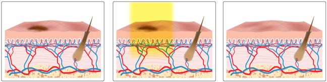 BBL Pigmented Lesion treatments work How does it work Unwanted Benign Lesion (brown spot) During BBL Treatment BroadBand Light penetrates the skin to reach the