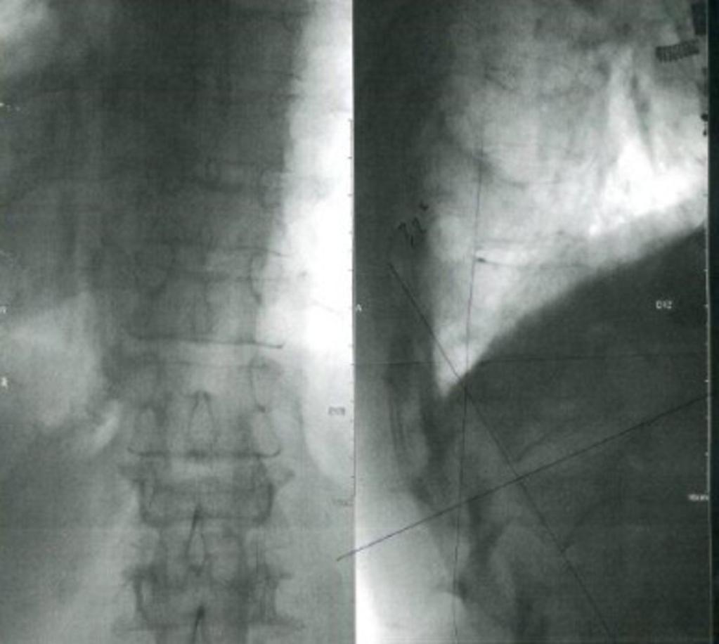 canes: 50 meters. Vertebral augmentation with SpineJack Ø 4.2mm and cement in L1 and concomitant preventive vertebroplasty in T12. Fig. 7: Inter-op radiographs. Fig. 8: Post-op CT scan.