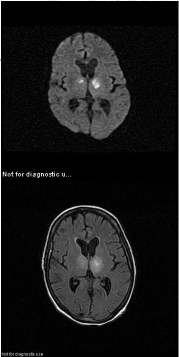 Date of admission WNV (June to October) 1 wk later 86% of encephalitis cases, 25% of meningitis, and 20% fever cases had abnormal neurological exams after acute infection Anomalies: abnormal motor