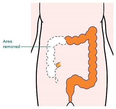 Types of operation for colon cancer Hemi-colectomy half of the colon is removed.