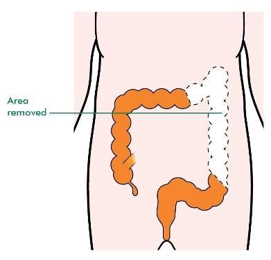 After removing the part of the bowel where the cancer is, the surgeon joins the two ends of the bowel together.