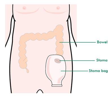 Stomas If the ends of the bowel cannot be joined together, part of the bowel can be brought out onto the tummy (abdomen).