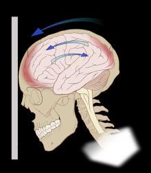 HEAD INJURY Should be suspected in all trauma cases Classification of Injury Closed type blunt force Penetrating type skull fracture Classification of