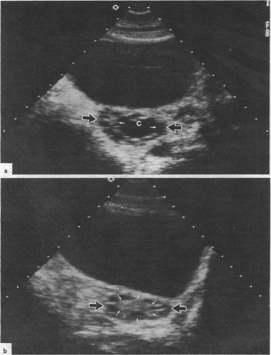 BRITISH MEDICAL JOURNAL VOLUME 293 9 AUGUST 1986 357 b FIG 2-Ultrasound appearance of ovary in women with polycystic ovaries but ovulatory cycles.