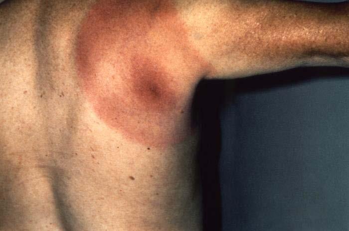 Lyme Disease Borrelia burgdorferi Symptoms Characteristic