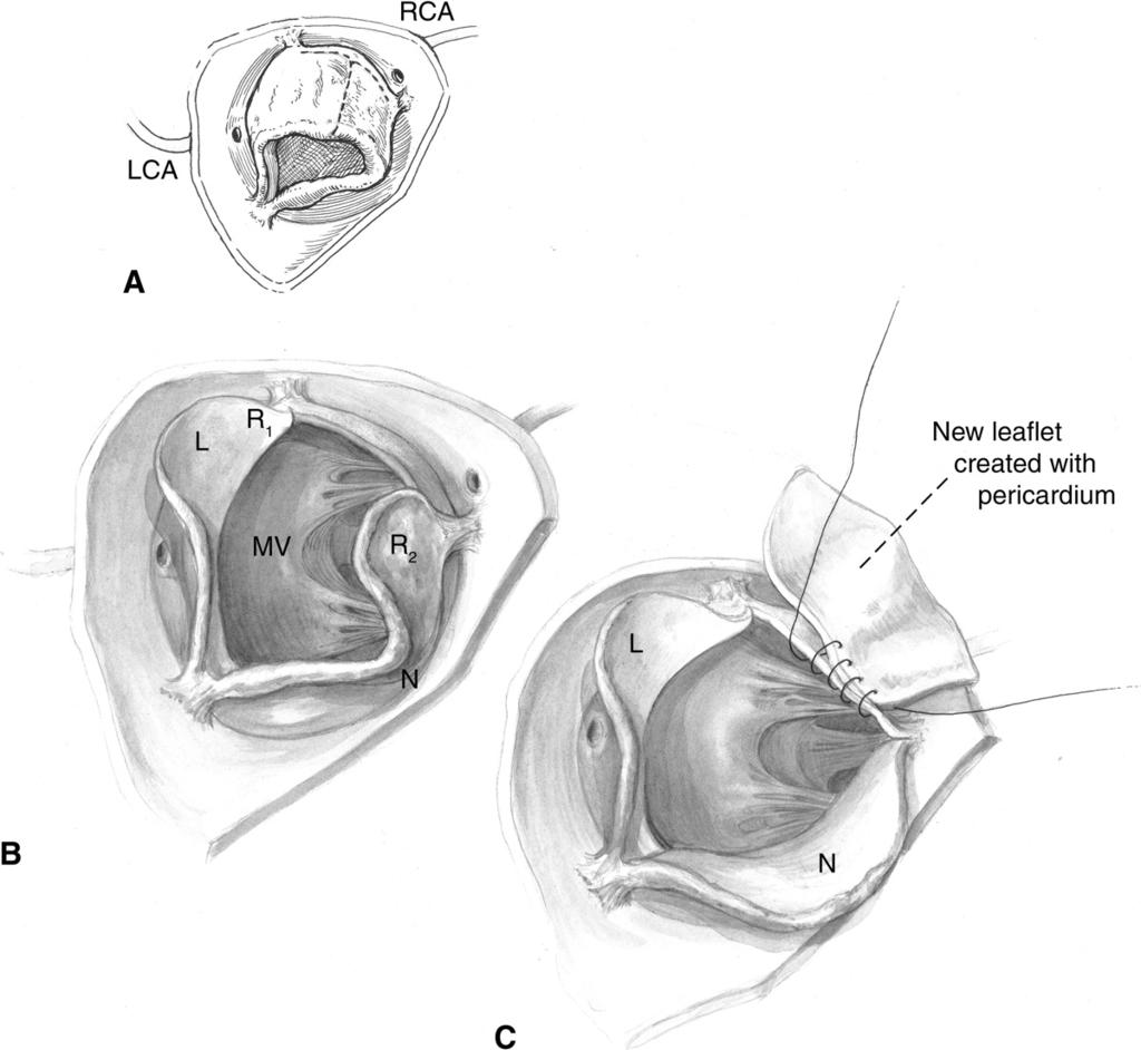260 C.W. Baird and P.J. del Nido Technique 2 Complete Right Leaflet Replacement Figure 6 Again, each part of the aortic valve complex is examined from the leaflet edges to the aortic root.