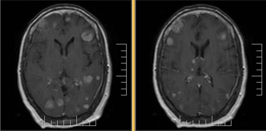 Figure 4: Axial contrast enhanced T1 weighted MR in a patient with meningitis showing thin linear diffuse leptomeningeal enhancement.