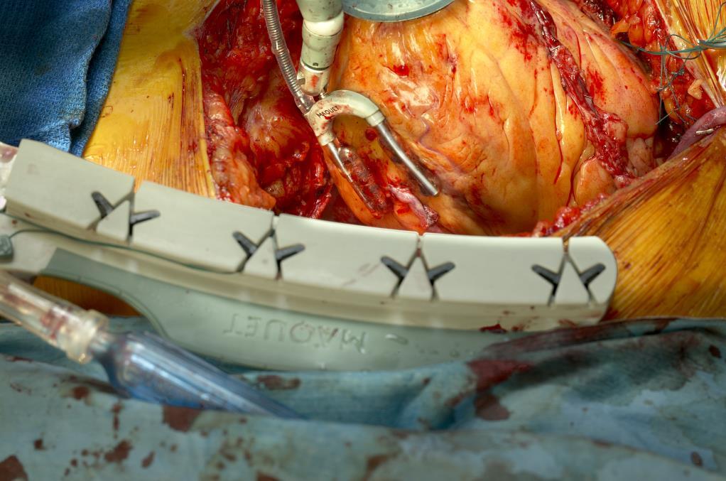 Lateral/Posterior Portion of the Heart Although displacing the heart to expose the circumflex marginal arteries can be one of the most challenging aspects of OPCAB, surgeons can successfully bypass