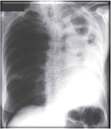 Chronic cavitary pulmonary aspergillosis (CCPA) Multiple cavities +/- fungal ball Radiological