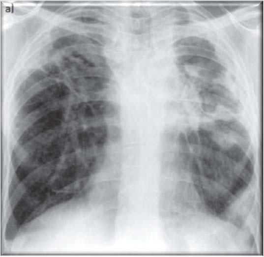 Chronic cavitary pulmonary aspergillosis (CCPA) Denning DW et al.