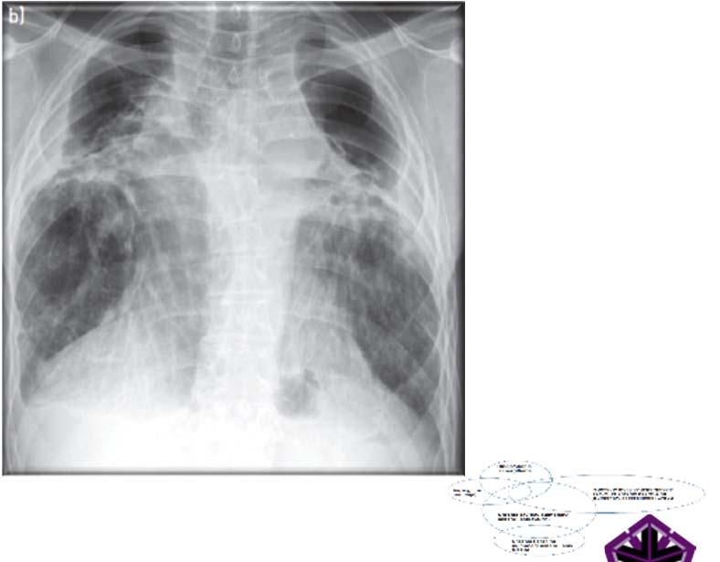 necrotizing or semi-invasive pulmonary aspergillosis Clinically and radiologically similar to CCPA but more