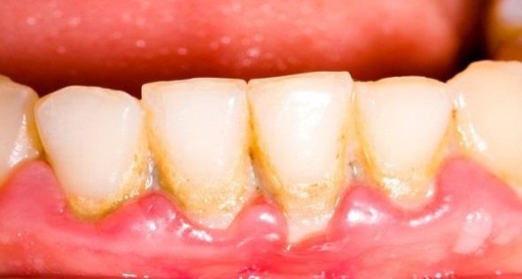 Dental Plaque is a biofilm on the surface of the teeth [12-18].
