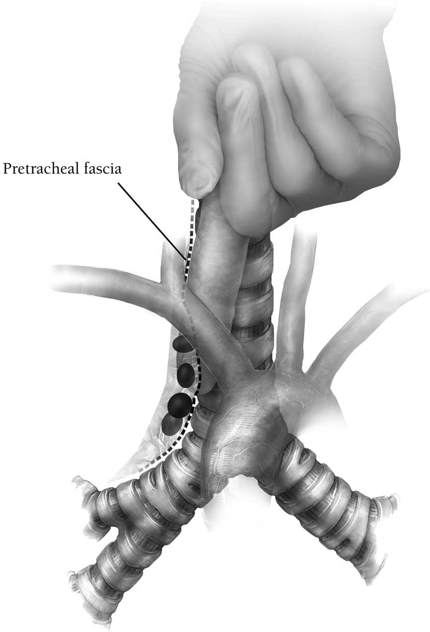 156 S.J. Mentzer Figure 4 The lower right paratracheal lymph nodes (level 4R) are located at the distal extent of the surgeon s finger and external to the pretracheal fascia.