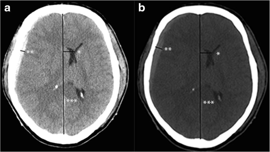 Bartels et al. BMC Neurology (2015) 15:220 Page 2 of 6 hematoma and the midline shift (MLS). If the MLS exceeds the thickness of the hematoma, then brain swelling should be supposed.