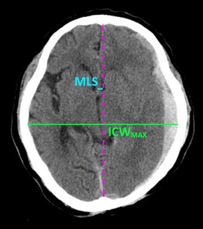 Fast and Automatic Midline Shift Measurement on Brain CT 3 IML passing through the center of the intracranial region.
