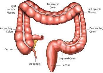 Colonoscopy Performance Considered the gold standard Not perfect 2-12% of large polyps are missed May