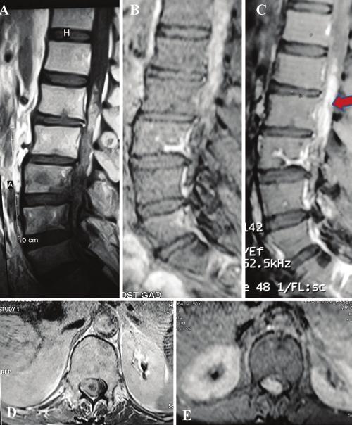 IgG4-related spinal pachymeningitis it showed moderate vascularity. No definite tumor was seen underneath the dura. The margins between normal and abnormal dura were difficult to discern.