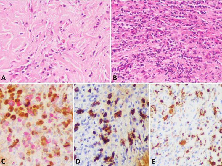 B. D. Radotra et al. Fig. 2. Case 1. Photomicrographs showing storiform fibrosis admixed with occasional eosinophils (A) and the presence of plasma cell rich infiltrate (B).
