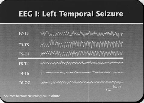 Seizure Evaluation Neuroimaging MRI with thin coronal cuts through