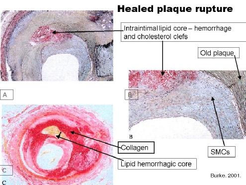 Figure (20): The fate of coronary thrombus following plaque rupture will determine the clinical outcome. Majority of coronary thrombi undergo spontaneous lysis and disappear.