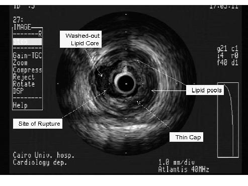 Coronary Imaging Intravascular Ultrasound: IVUS - Provides two dimensional cross-sectional tomographic views.
