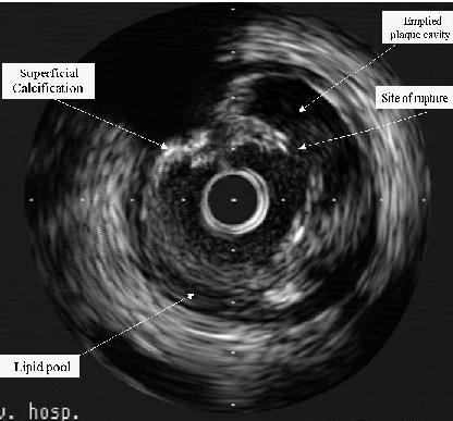 Figure (23): IVUS showing a ruptured plaque with area of calcification. Calcification produce a dark shadow that masks the underlying tissue.