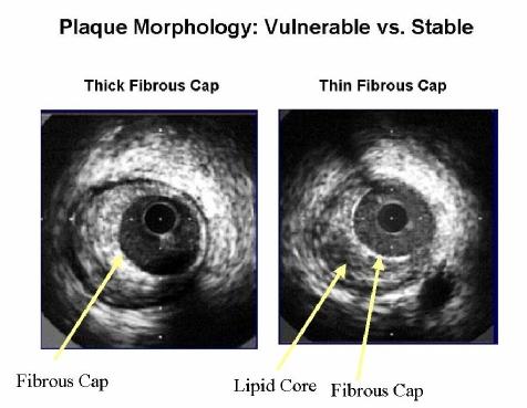 Figure (24): IVUS can help identification of plaque morphology and structure. Stable plaques have thick fibrous cap which appears as dense white strongly echogenic structure (left image).