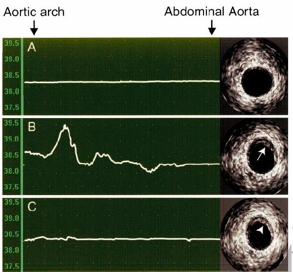 Figure (27): Recording of temperature through thermography catheter in rabbit passed from aortic arch to abdominal aorta. Arrow points to atherosclerotic plaques.